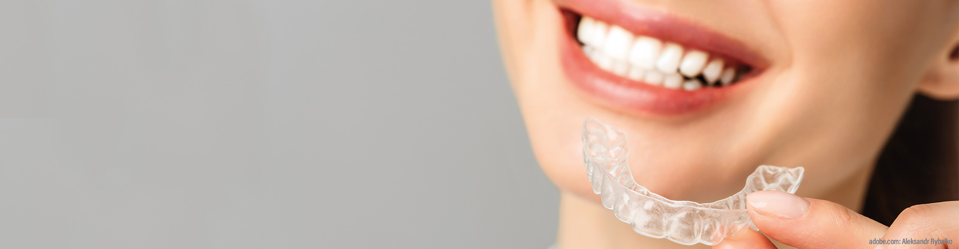 Veneers